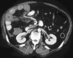 Ischemic Colitis - CTisus CT Scan