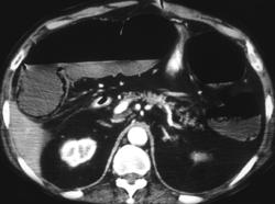 Infarcted Bowel With Pneumatosis. Portal Venous Air Also Seen. - CTisus CT Scan