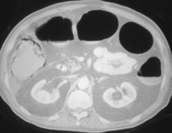 Infarcted Colon With Pneumatosis - CTisus CT Scan