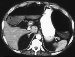 Scrotal Hernia and Infarcted Bowel - CTisus CT Scan