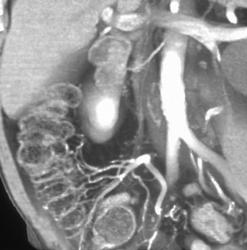 Normal Vessels to the Cecum and Ileum - CTisus CT Scan