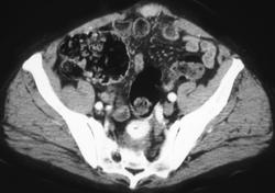 Bleeding Arteriovenous Malformation (AVM) in Colon - CTisus CT Scan