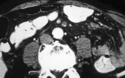 Partial Thrombosis of the Superior Mesenteric Vein (SMV) - CTisus CT Scan