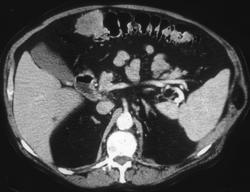 Implants on Colon - CTisus CT Scan