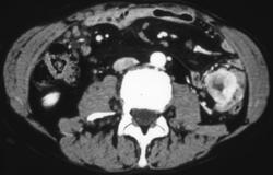 GIST Tumors - CTisus CT Scan