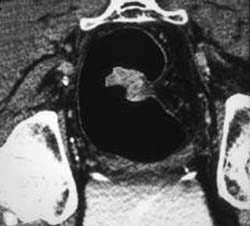 Rectal Cancer - CTisus CT Scan