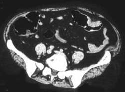 Colon Cancer - CTisus CT Scan