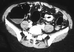 Colon Cancer - CTisus CT Scan