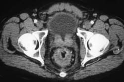 Rectal Cancer - CTisus CT Scan