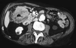 Hepatic Flexure Cancer Invades the Duodenum - CTisus CT Scan