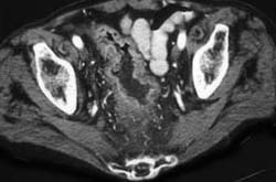 Rectal Cancer - CTisus CT Scan