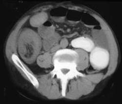 Cecal Cancer With Intussusception - CTisus CT Scan