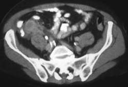 Dilated Appendix Obstructed By Cecal Cancer - CTisus CT Scan