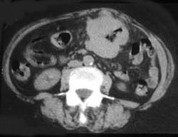 Lymphoma of Small Bowel - CTisus CT Scan