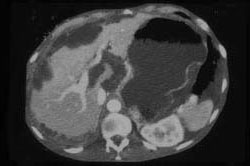 Pseudomyxoma Peritonei (PMP) - CTisus CT Scan