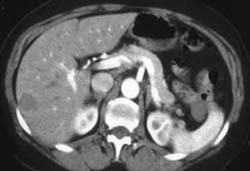 Liver Metastases - CTisus CT Scan