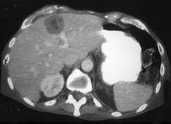 Colon Cancer With Liver Metastases and Supraclavicular Nodes - CTisus CT Scan