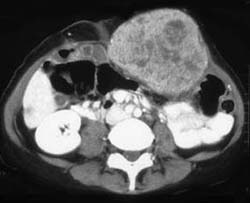 Recurrent Tumor in the Abdominal Wall - CTisus CT Scan