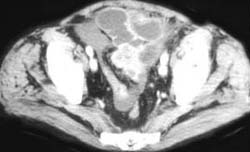 Small Bowel Obstruction (SBO) Due to Recurrent Colon Cancer in Pelvis - CTisus CT Scan