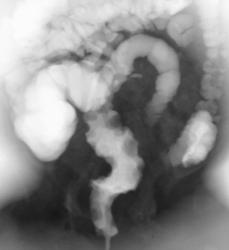 Hemangiomas of the Colon - CTisus CT Scan