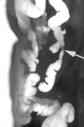 Stricture of the Colon Due to Ischemia - CTisus CT Scan