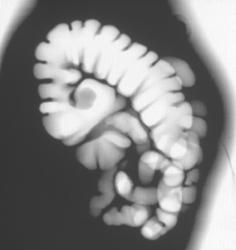 Cecal Cancer - CTisus CT Scan