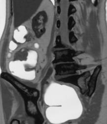 Colon Cancer Arises in A Polyp - CTisus CT Scan