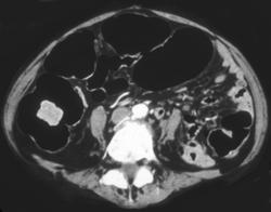 Cecal Cancer - CTisus CT Scan