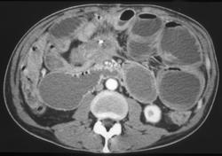 Tumor in Mesentery Causing Small Bowel Obstruction (SBO) - CTisus CT Scan