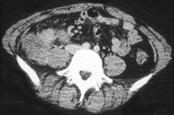 Recurrent Colon Cancer in the Right Lower Quadrant - CTisus CT Scan