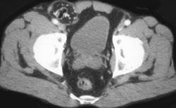 Scrotal Hernia - CTisus CT Scan