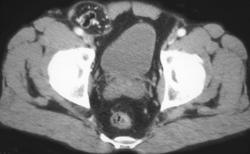 Hernia of Bowel Into Scrotum - CTisus CT Scan