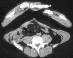 Recurrent Mucinous Colon Cancer in Right Lower Quadrant With Falsely Negative PET Scan - CTisus CT Scan