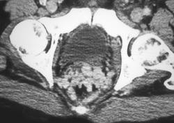 Rectal Varices - CTisus CT Scan