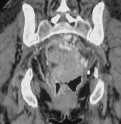 Bulky Ulcerating Colon Cancer - CTisus CT Scan