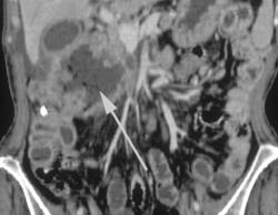 Perforated Hepatic Flexure Cancer - CTisus CT Scan