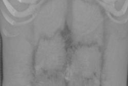 Artifacts Generated By Contrast on Scanner Strapes - CTisus CT Scan