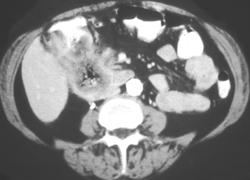 Hepatic Flexure Carcinoma - CTisus CT Scan