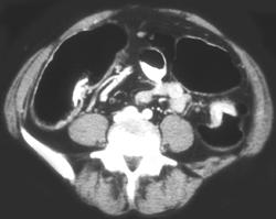 Carcinoma of the Descending Colon - CTisus CT Scan