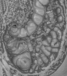 Polyp in Cecum - CTisus CT Scan