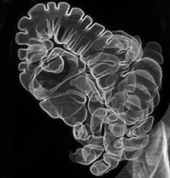 Polyp in Right Colon - CTisus CT Scan