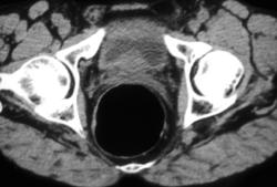 Rectal Cancer - CTisus CT Scan