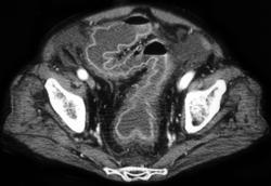 Pseudomembranous Colitis (PMC) With Enhancing Wall - CTisus CT Scan