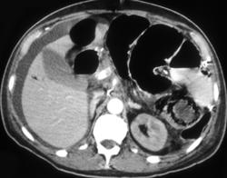 Pneumatosis With Infarcted Bowel - CTisus CT Scan