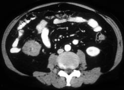 Carcinoma of the Right Colon - CTisus CT Scan