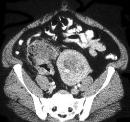 Perforated Cecal Cancer - CTisus CT Scan