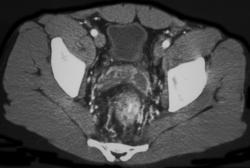 Perirectal Inflammation and Seminal Vesicle Abscess in Crohn's Patient ...