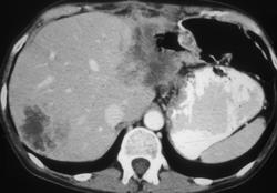 Recurrent Colon Cancer Invades the Stomach - CTisus CT Scan