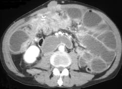 Recurrent Colon Cancer Causes An Small Bowel Obstruction (SBO) - CTisus CT Scan