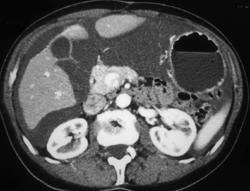 Carcinomatosis - CTisus CT Scan